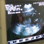 Ultrasound-Gender-Selective