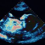 baby-scan-girl-abortion